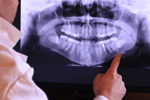 Best Emergency Dental Care for Broken or Chipped Teeth in New London, IA
